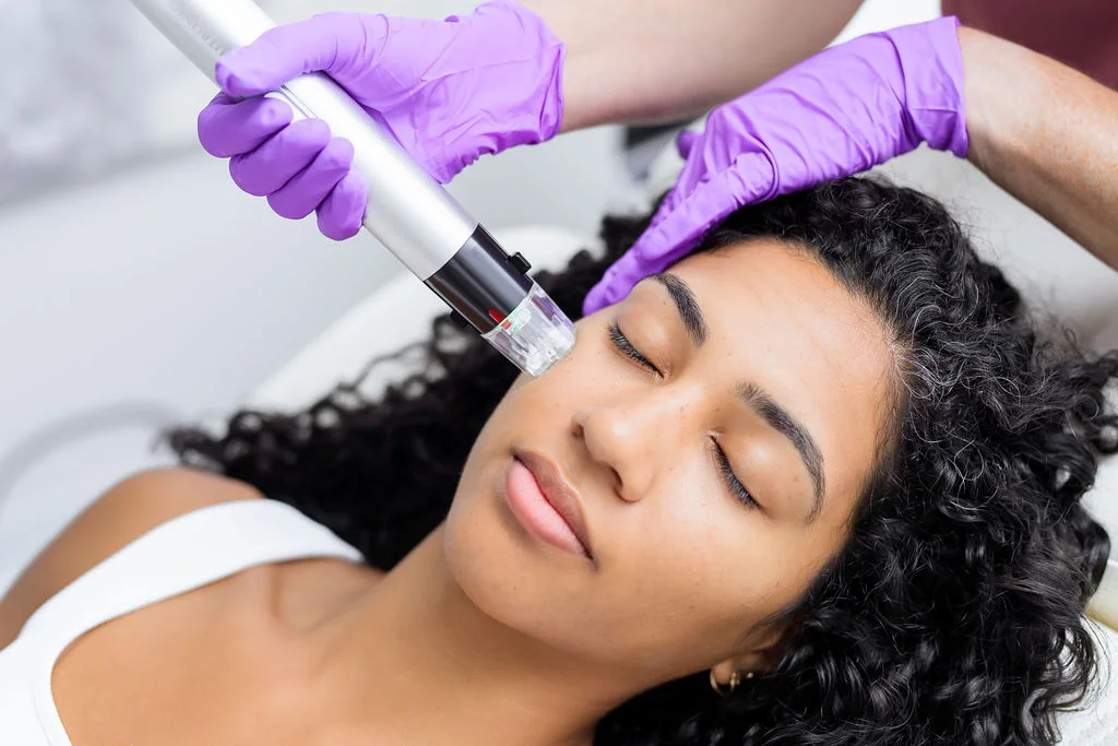 RF Microneedling in Plano, TX & Desoto, TX by Noble Cosmetic Surgery