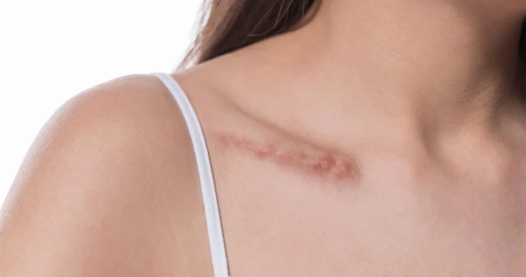 Hypertrophic Treatment in Plano, TX & Desoto, TX by Noble Cosmetic Surgery