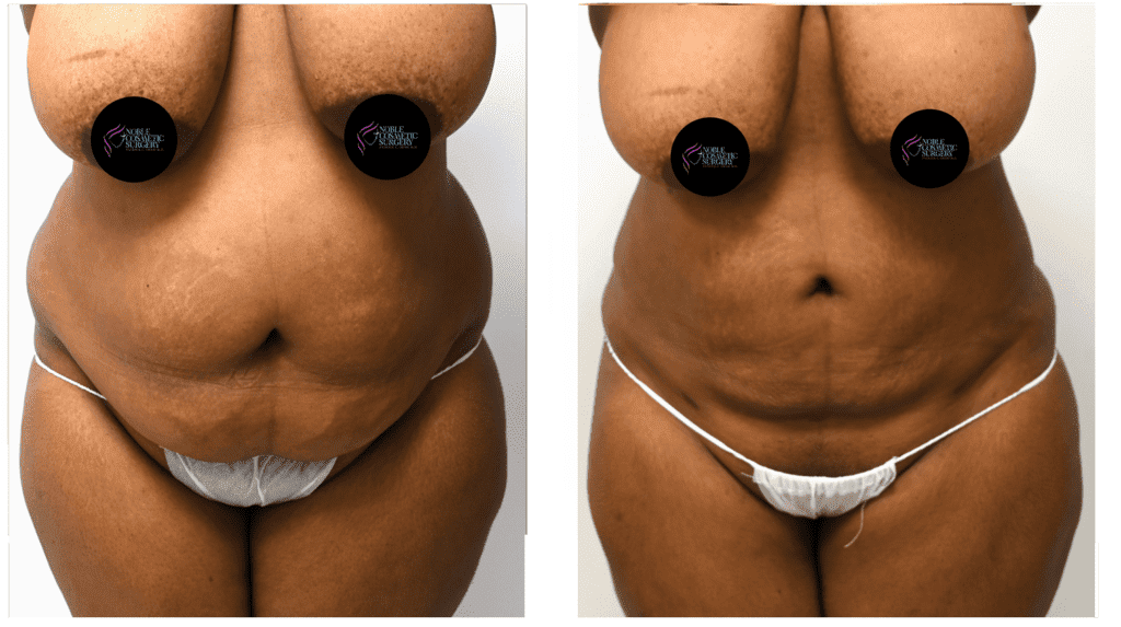 Female-Liposuction-before-after-Full-Front-B-By-Noble-Cosmetic-Surgery