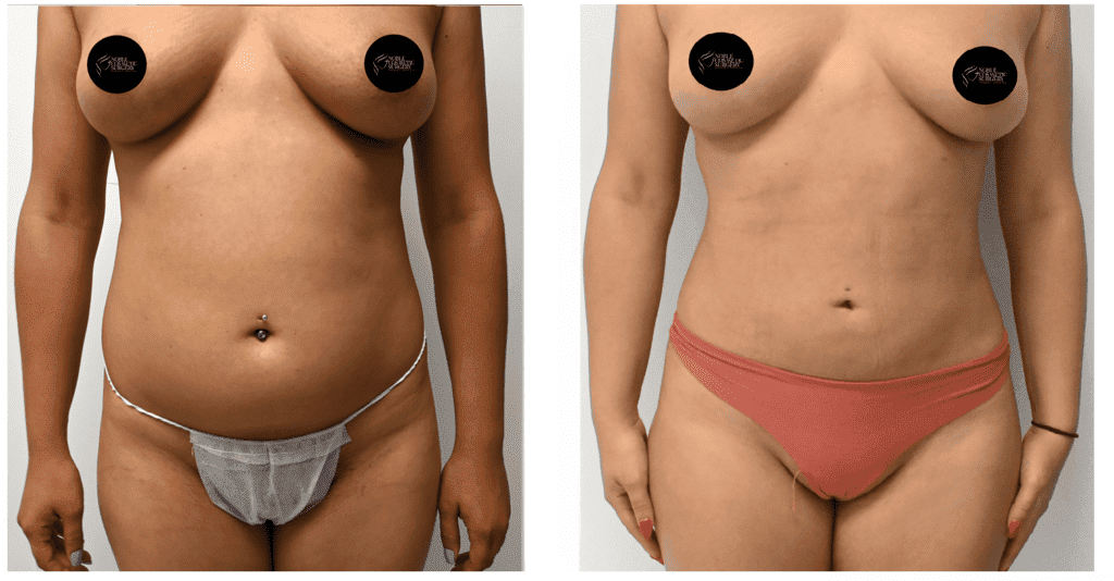 Female-Liposuction-before-after-Full-Side-Front-By-Noble-Cosmetic-Surgery