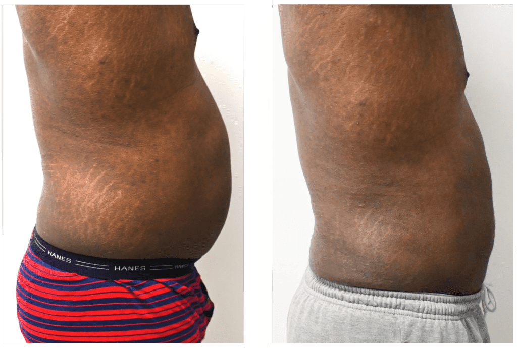 Liposuction-before-after-Right-Side-By-Noble-Cosmetic-Surgery