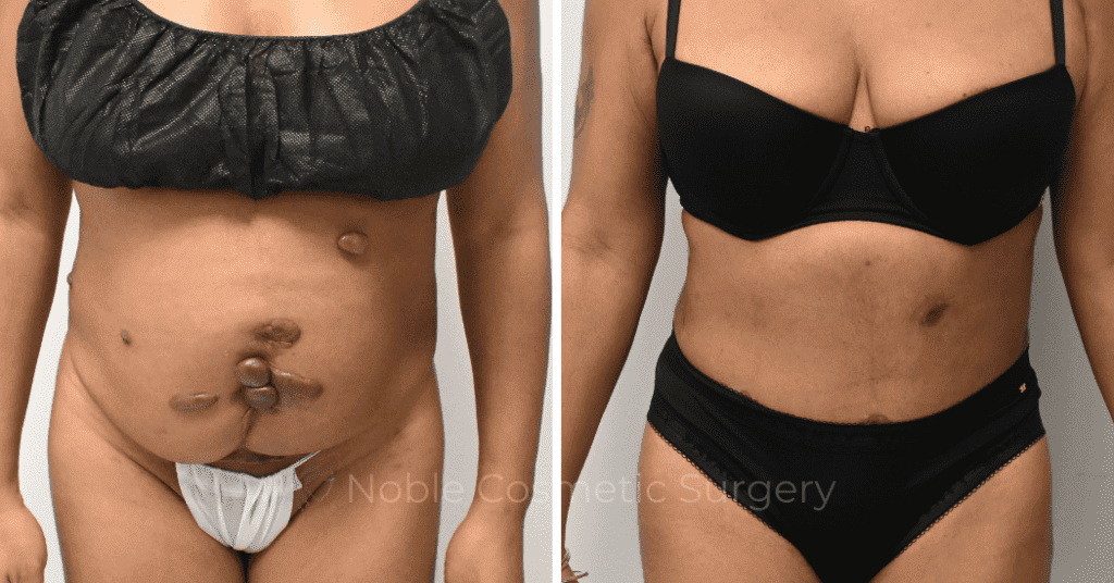 TUMMY TUCK CASE 10972