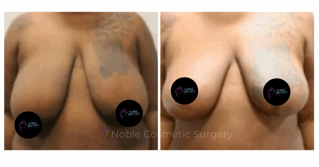 BREAST REDUCTION CASE 18364