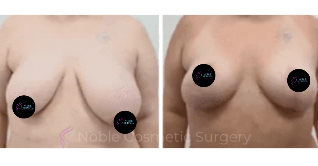 BREAST REDUCTION CASE 19223