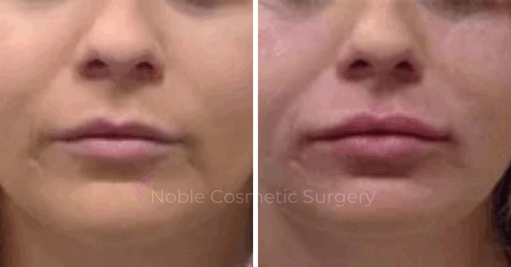DERMAL FILLERS CASE 00258