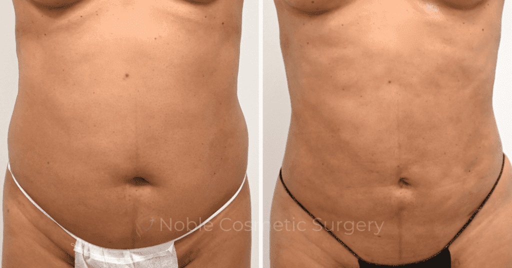 LIPOSUCTION CASE 12162