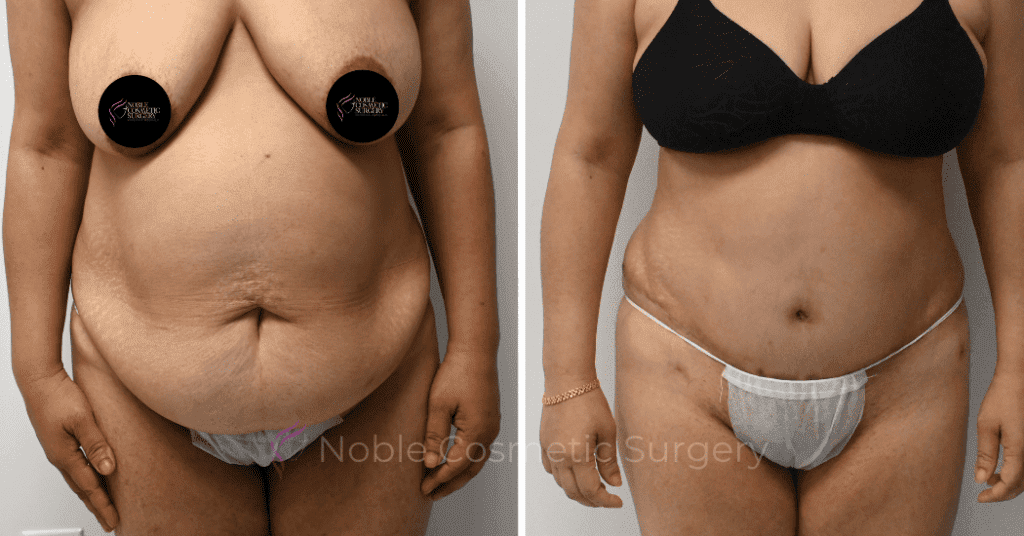 TUMMY TUCK CASE 11285