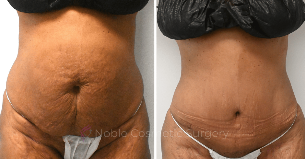 TUMMY TUCK CASE 10626