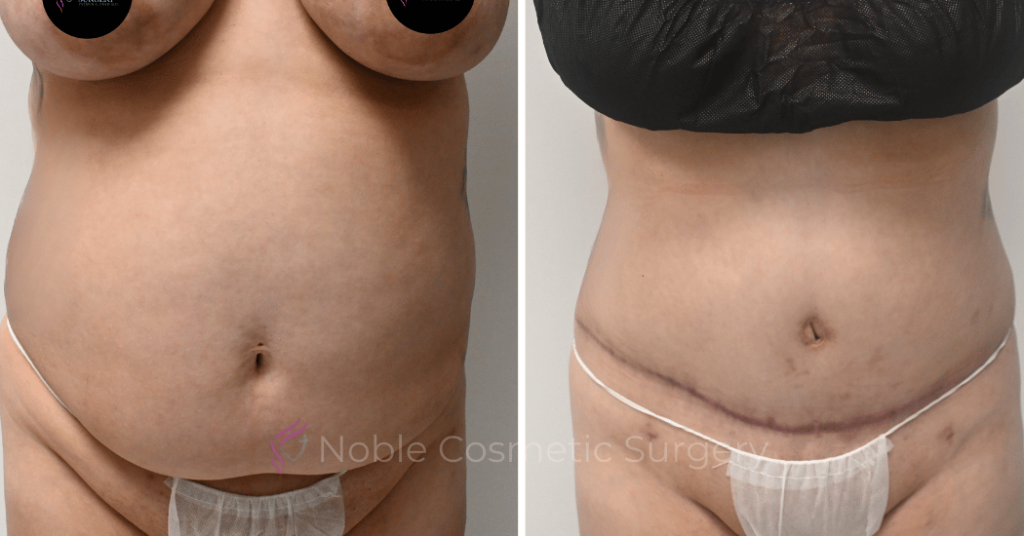 TUMMY TUCK CASE 10538