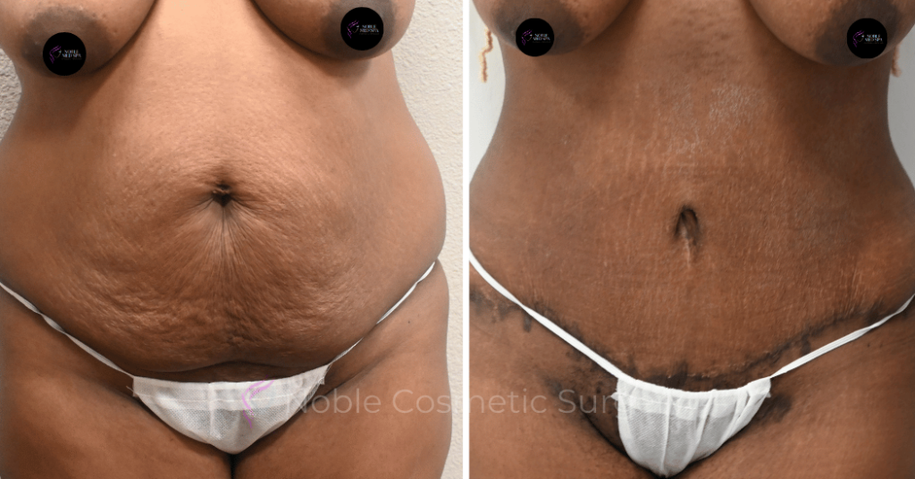 TUMMY TUCK CASE 13859