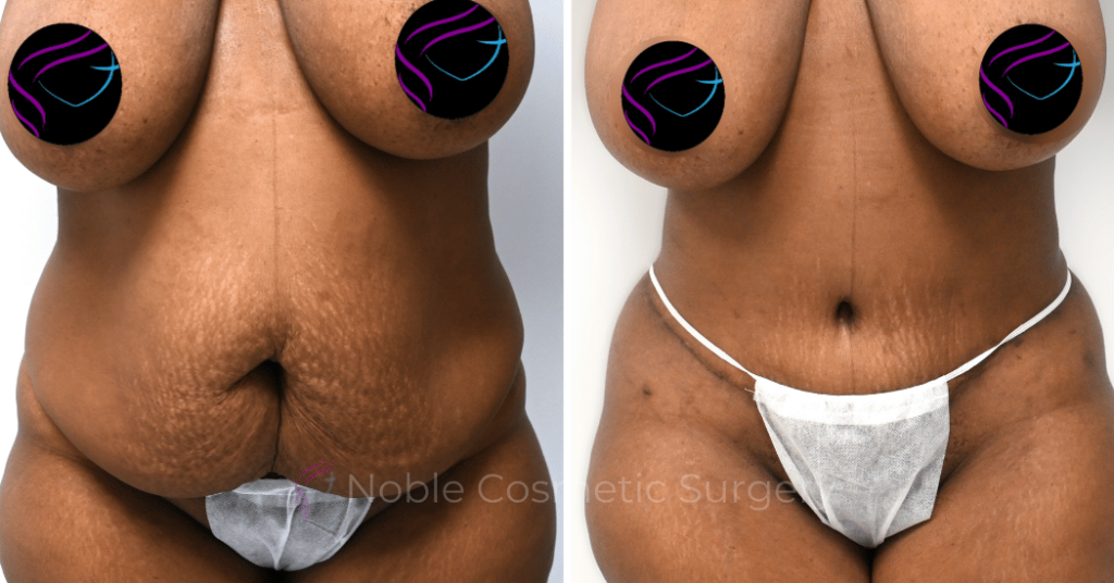 TUMMY TUCK CASE 14435