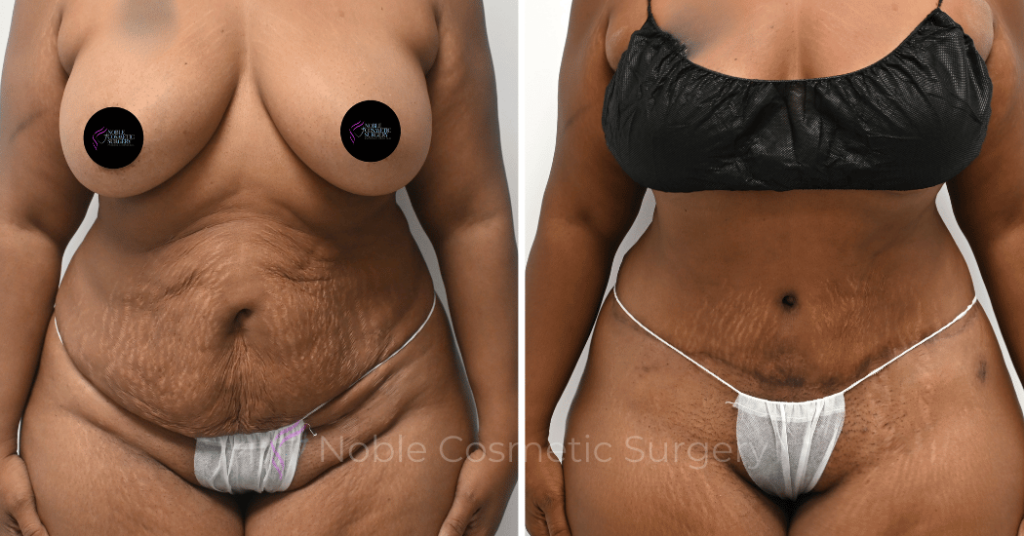 TUMMY TUCK CASE 14814