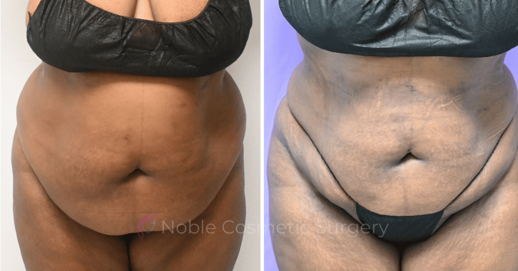 LIPOSUCTION ABDOMEN CASE 19096