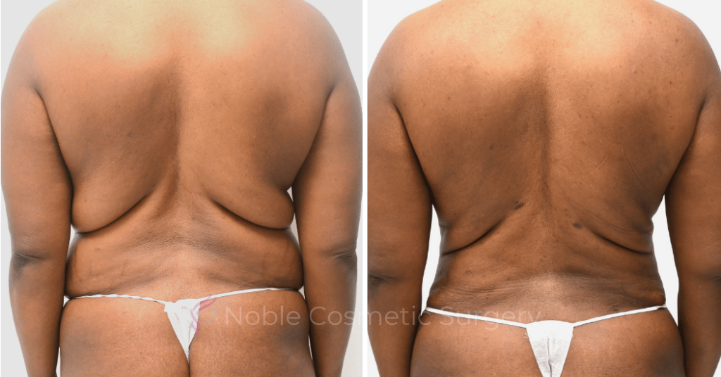 LIPOSUCTION ABDOMEN CASE 12002