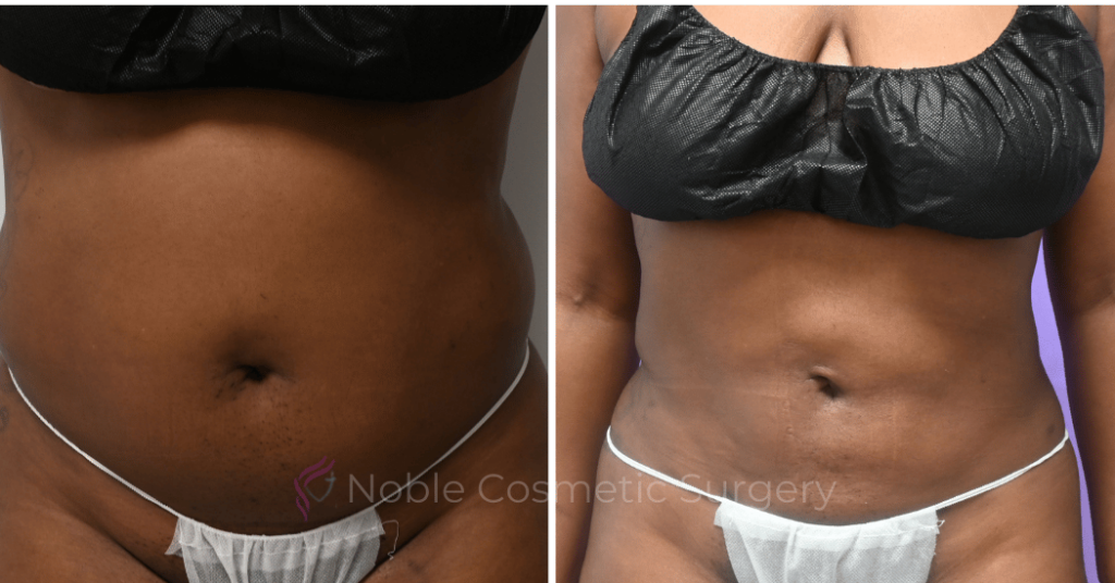 LIPOSUCTION ABDOMEN CASE 10873