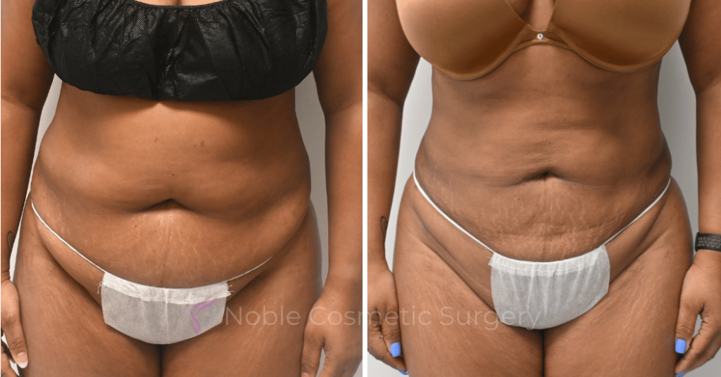 LIPOSUCTION ABDOMEN CASE 16787