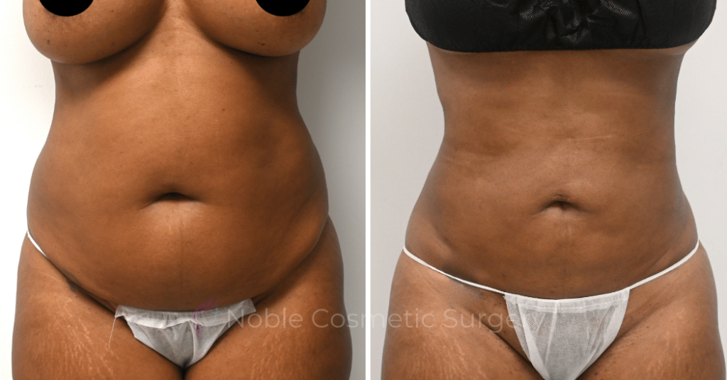 LIPOSUCTION ABDOMEN CASE 11016