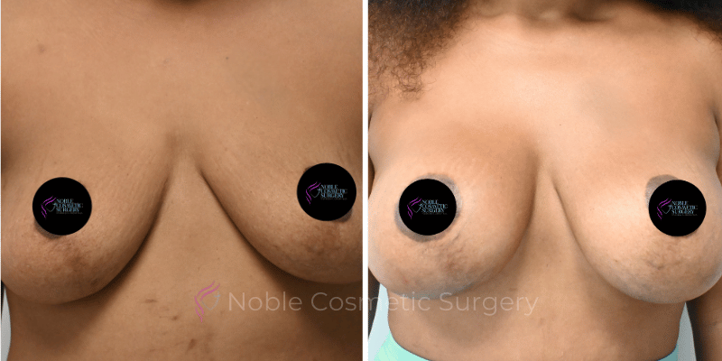 BREAST AUGMENTATION CASE 11356