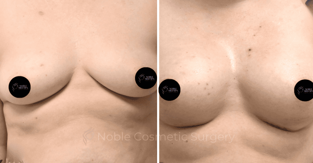 BREAST AUGMENTATION CASE 11771