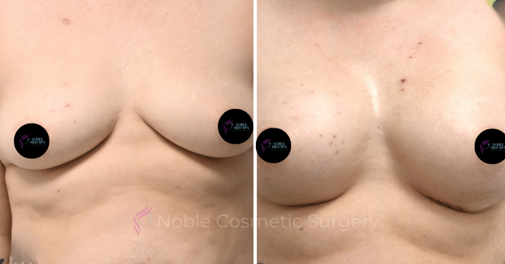 BREAST AUGMENTATION CASE 12478