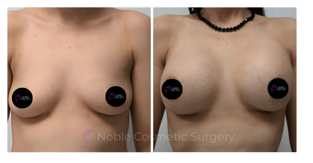 BREAST AUGMENTATION CASE 11661