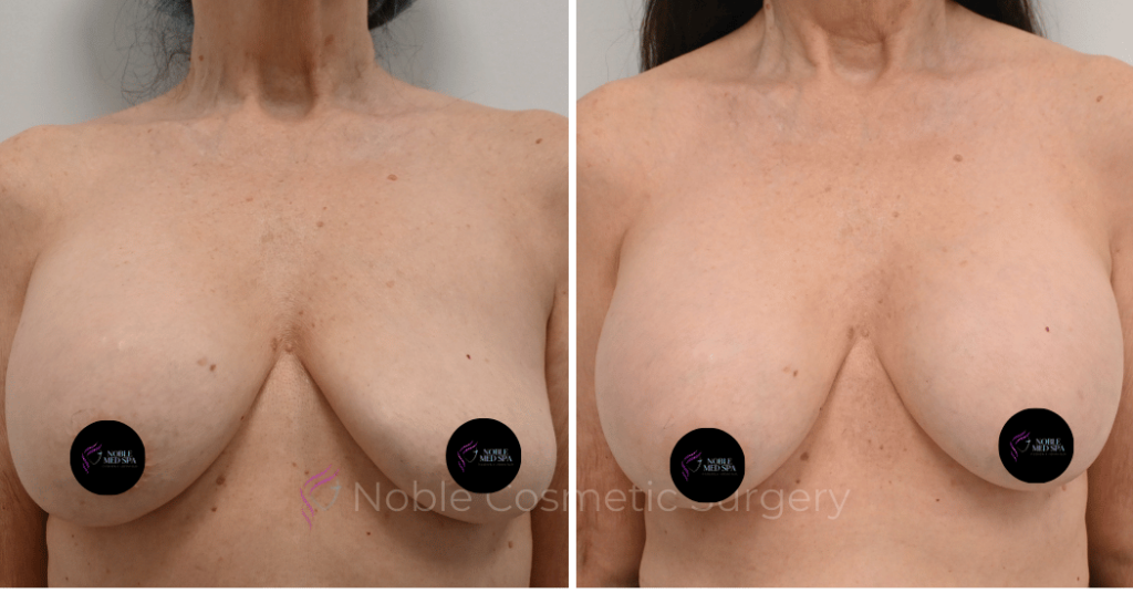 BREAST AUGMENTATION CASE 12085