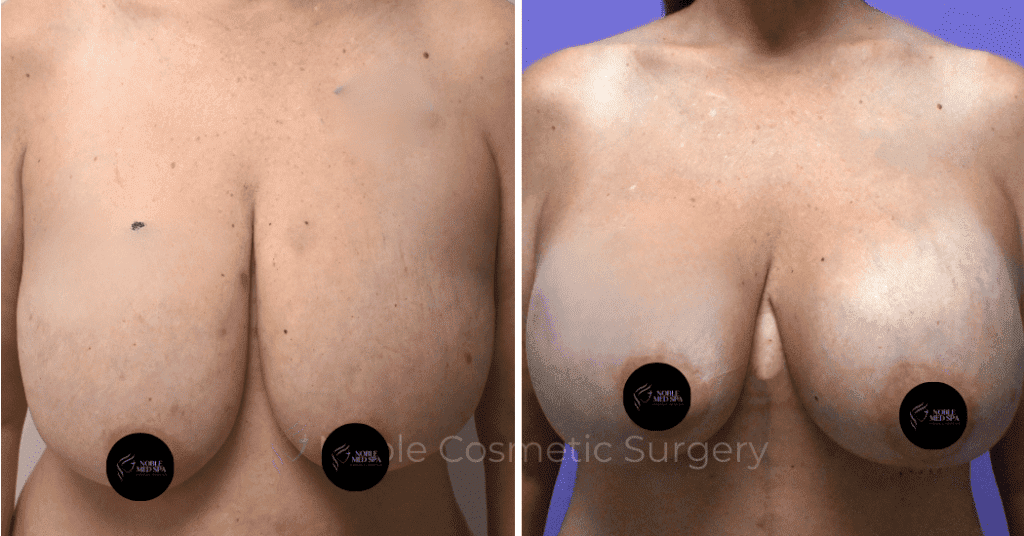 BREAST AUGMENTATION CASE 10275