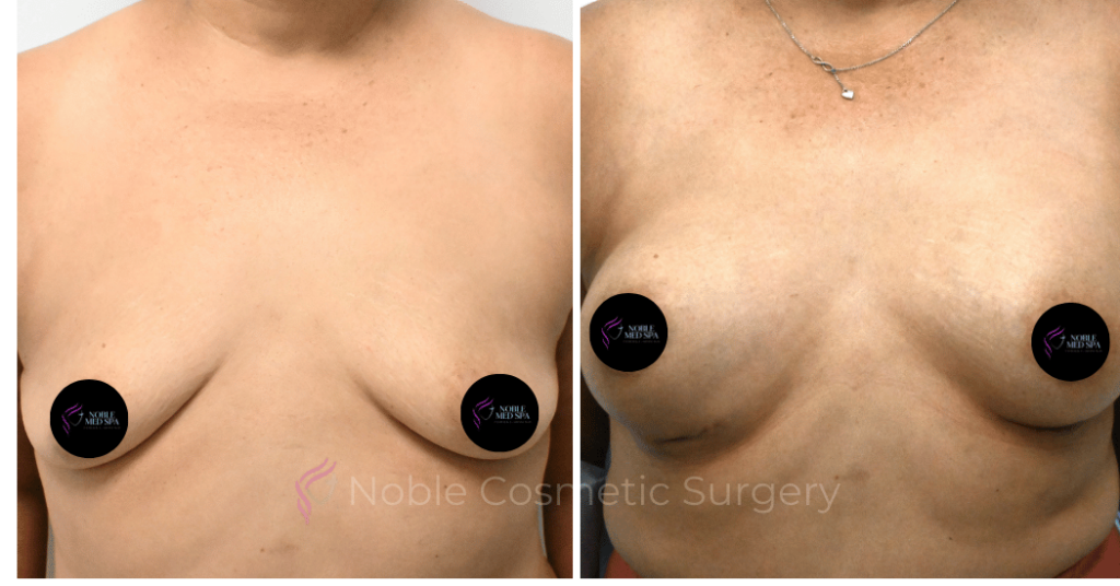 BREAST AUGMENTATION CASE 10545