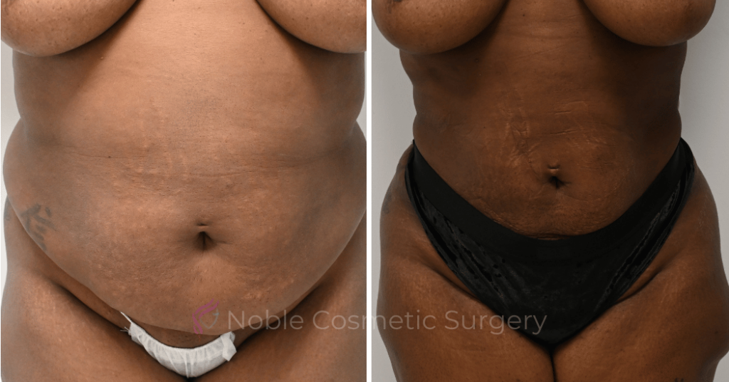 LIPOSUCTION CASE 15837