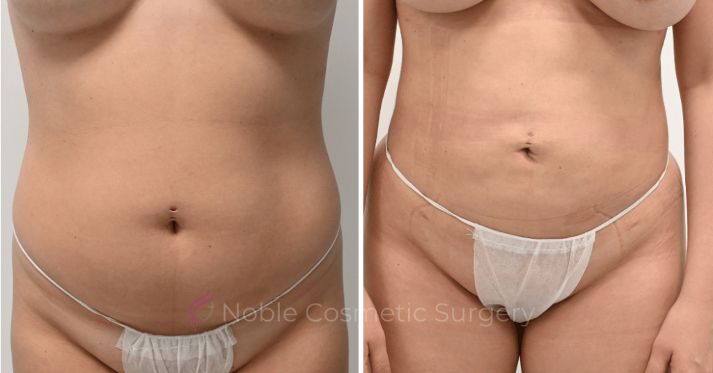 LIPOSUCTION CASE 11801