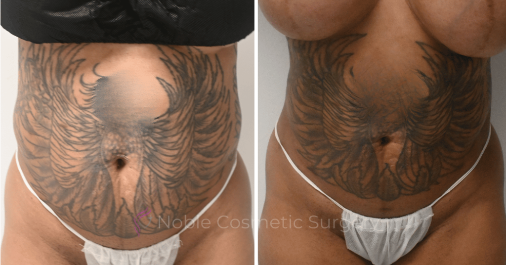 LIPOSUCTION CASE 10243