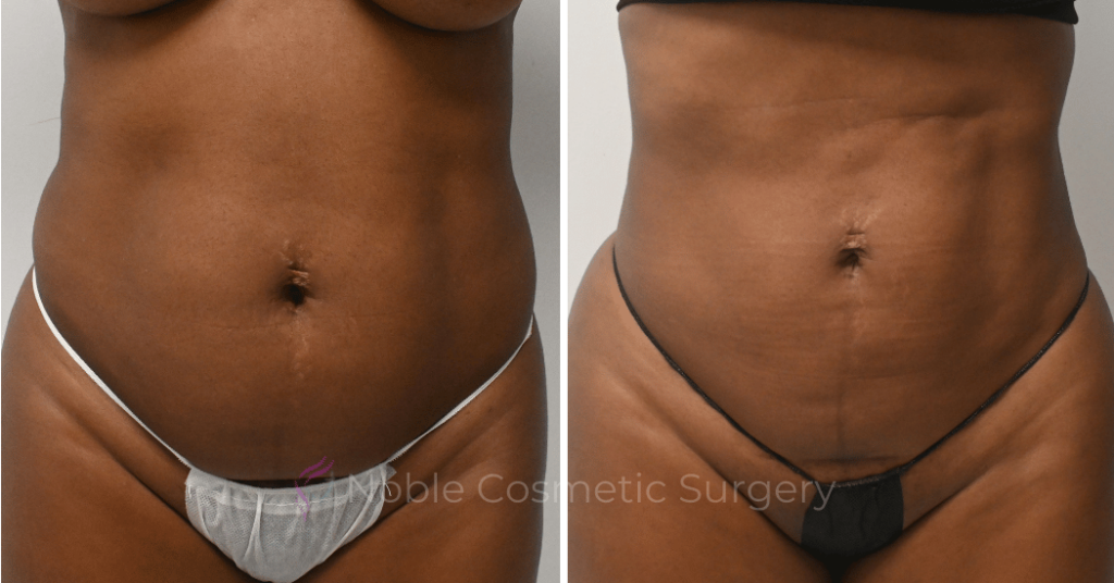 LIPOSUCTION CASE 10510