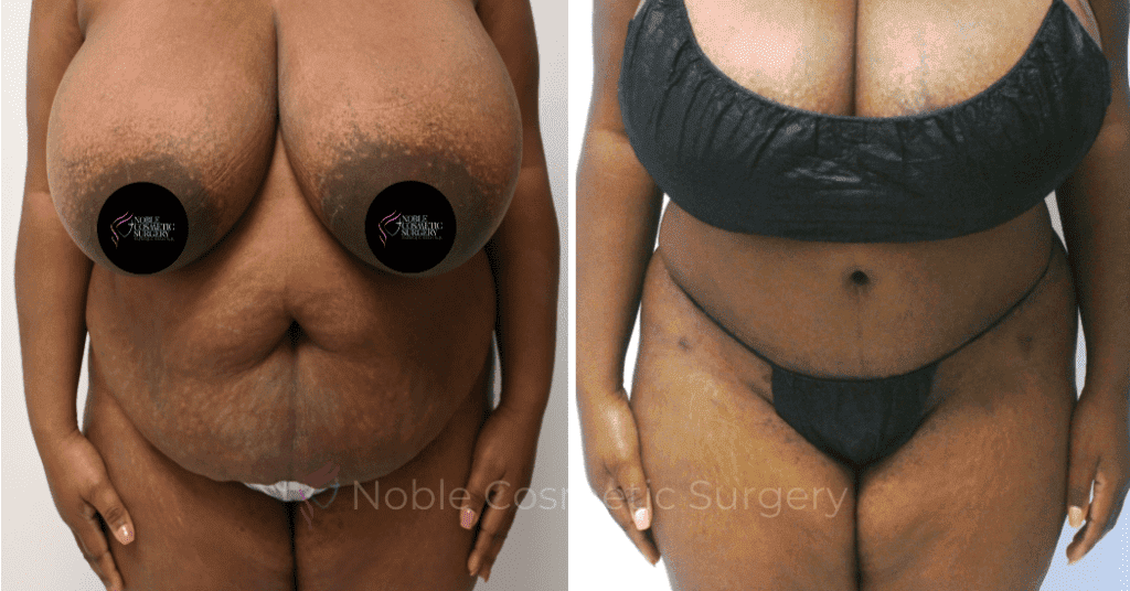 TUMMY TUCK CASE 11720