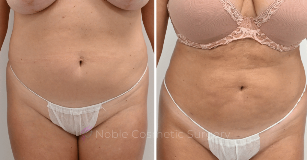 LIPOSUCTION CASE 13006