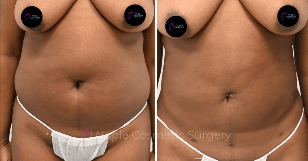 LIPOSUCTION CASE 12998