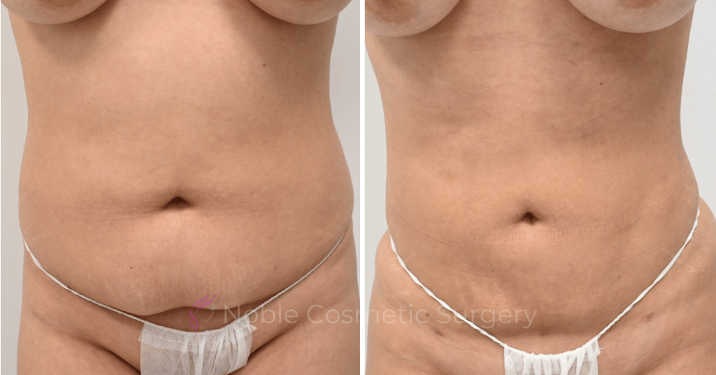 LIPOSUCTION CASE 12977