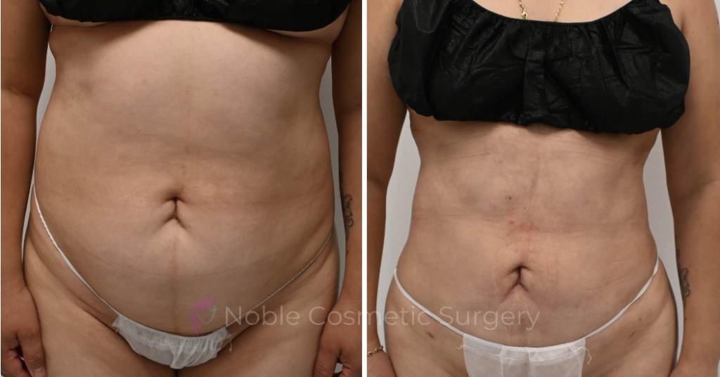 LIPOSUCTION CASE 11116