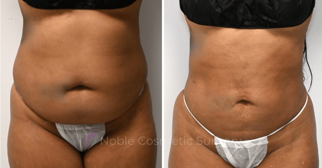 LIPOSUCTION CASE 10929