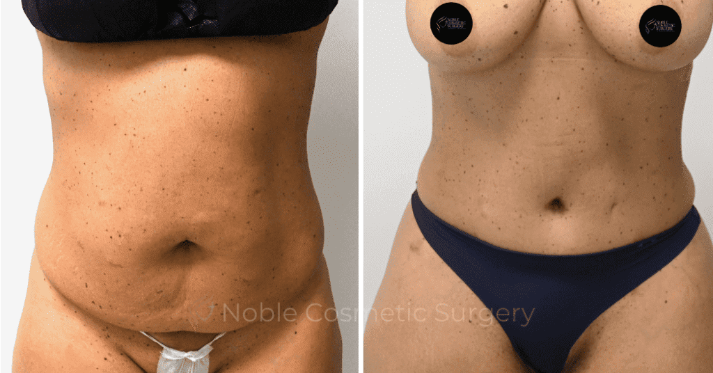 TUMMY TUCK CASE 10616