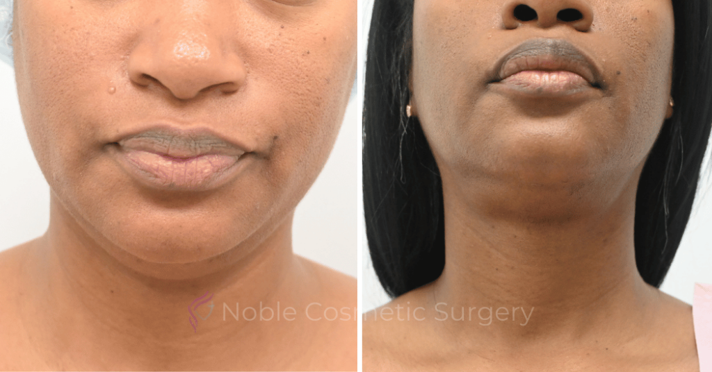 LIPOSUCTION SUBMENTAL CASE 12998