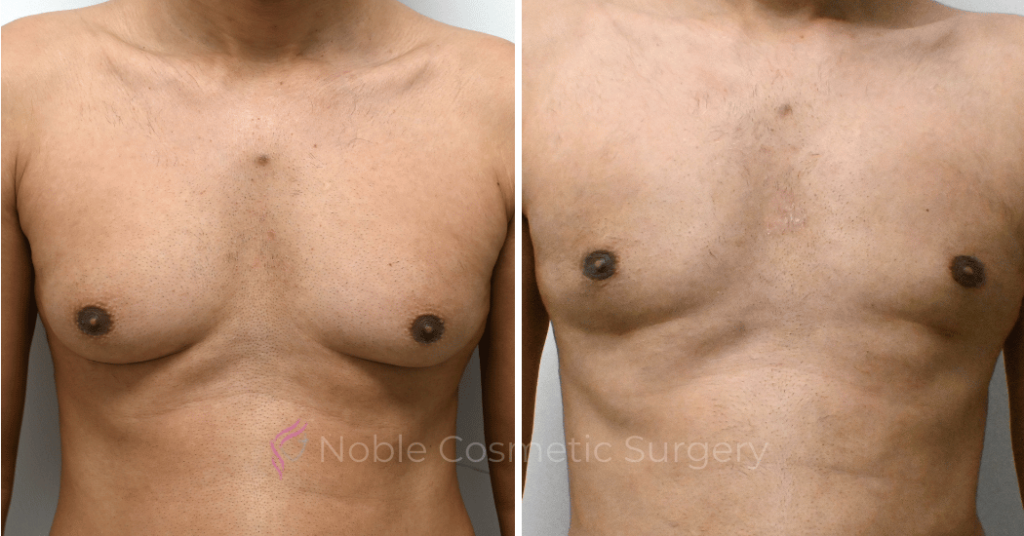 GYNECOMASTIA CASE 10707