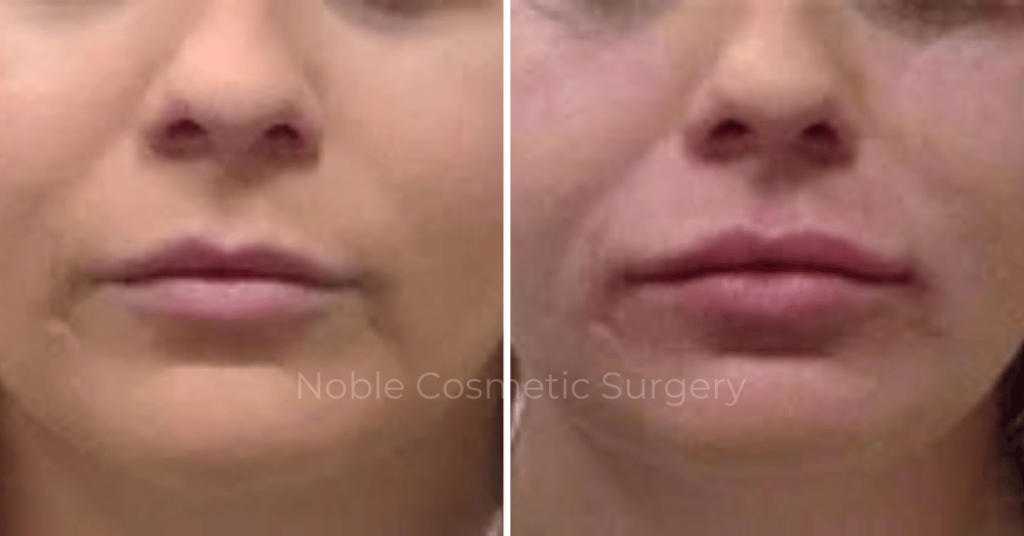 Dermal Fillers Case 00252