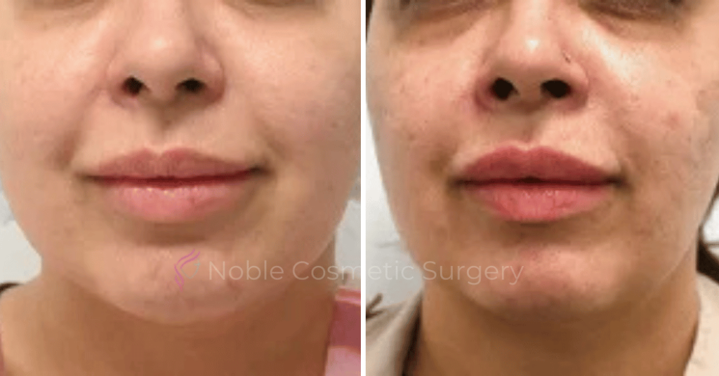 Dermal Fillers Case 00253