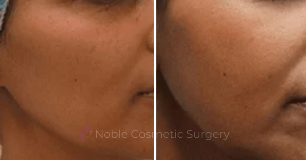 LIPOSUCTION SUBMENTAL (CHIN) 20256