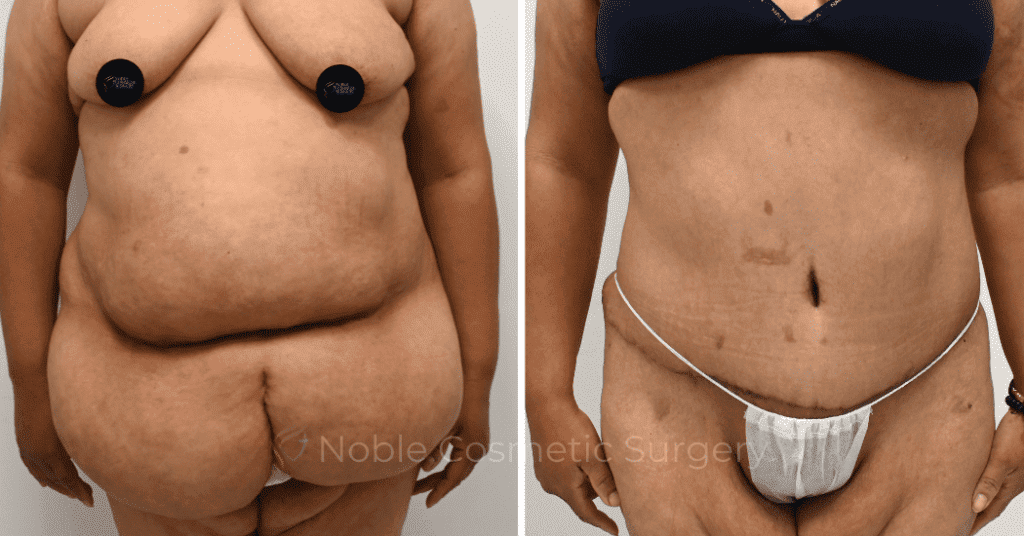 TUMMY TUCK CASE 12513