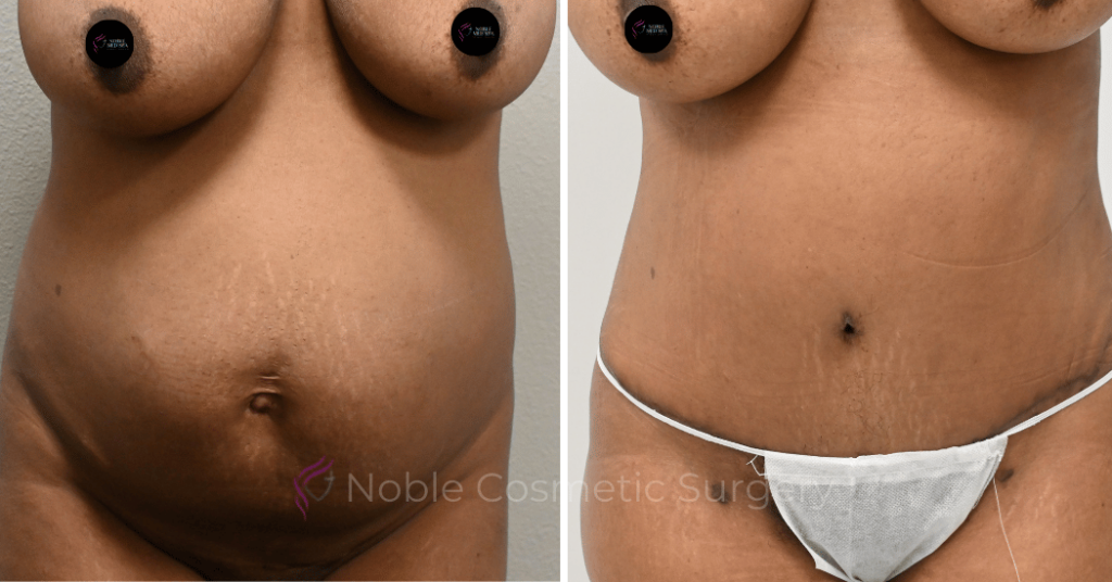 TUMMY TUCK CASE 14407