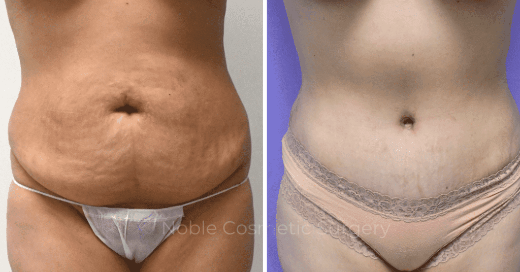 TUMMY TUCK CASE 19130