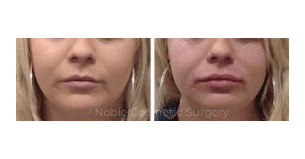 Dermal Fillers Case 00252