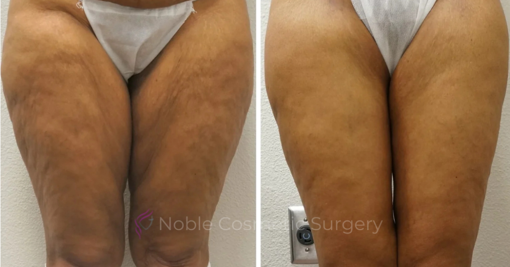 Thigh Lift Case 10385