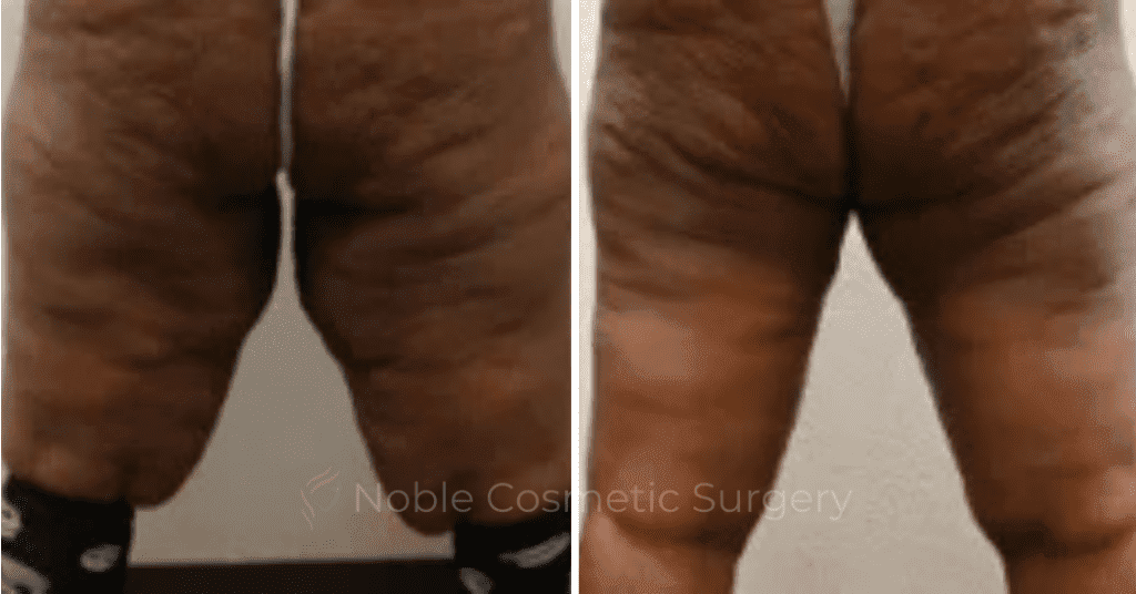 Thigh Lift Case 10388